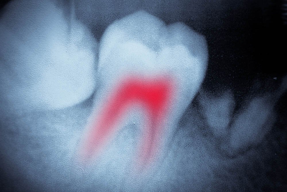 root canal nerve in red
 - Costa Rica